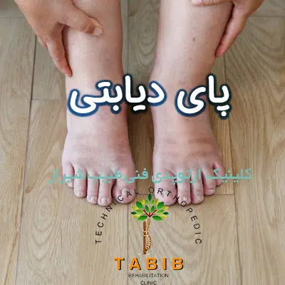 درمان پای دیابتی در شیراز