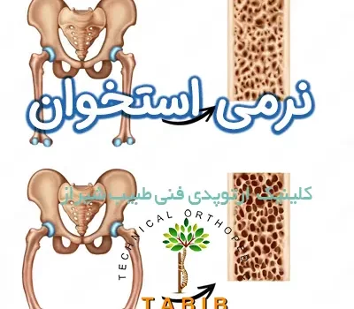 درمان نرمی استخوان در شیراز