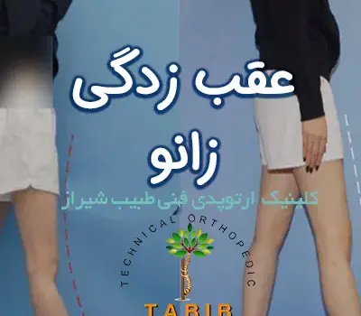 عقب زدگی زانو چیست