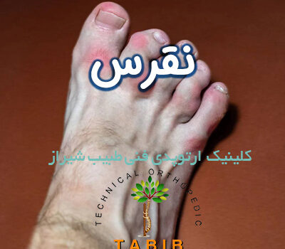 درمان نقرس در شیراز