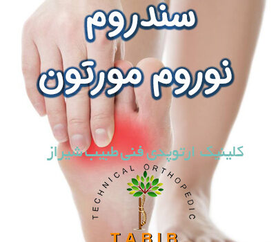 سندروم نوروم مورتون